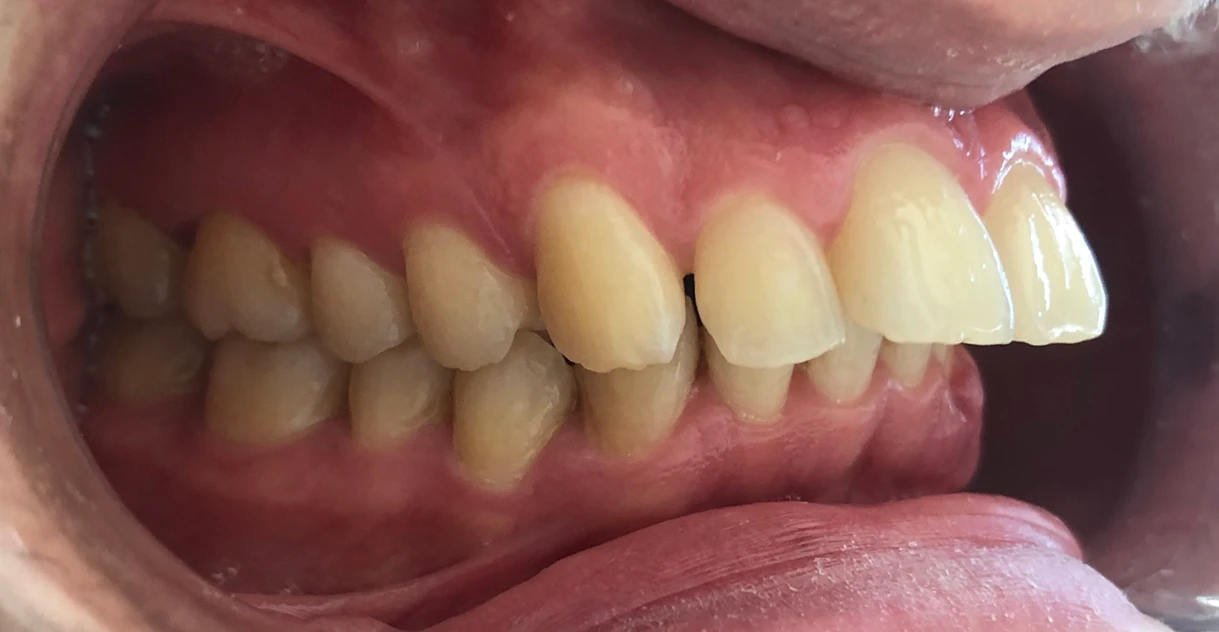 Antes - Traitement orthodontique avec des aligneurs.