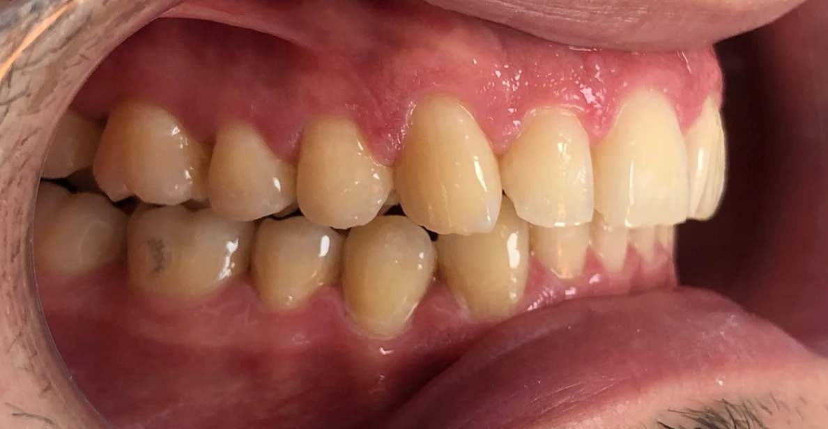Depois - Traitement orthodontique avec des aligneurs.