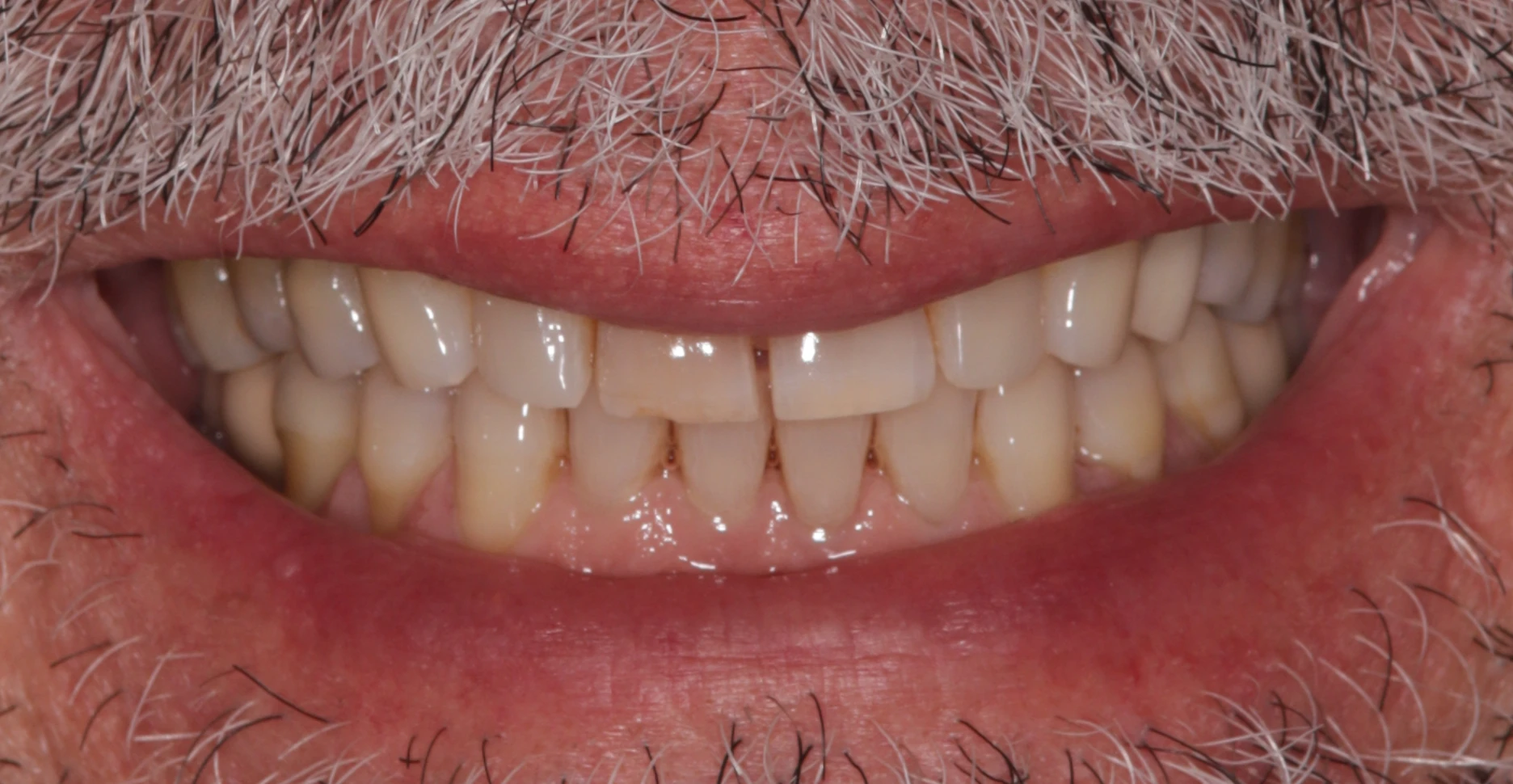 Antes - Réhabilitation orale avec facettes dentaires
