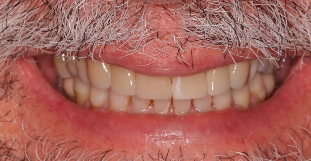 Depois - Réhabilitation orale avec facettes dentaires