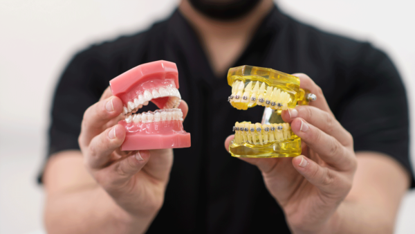 Types of dental braces