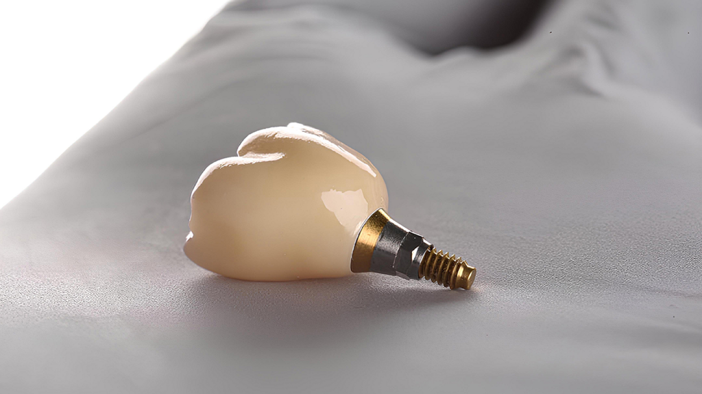 Implant dentaire: récupération et soins postopératoires