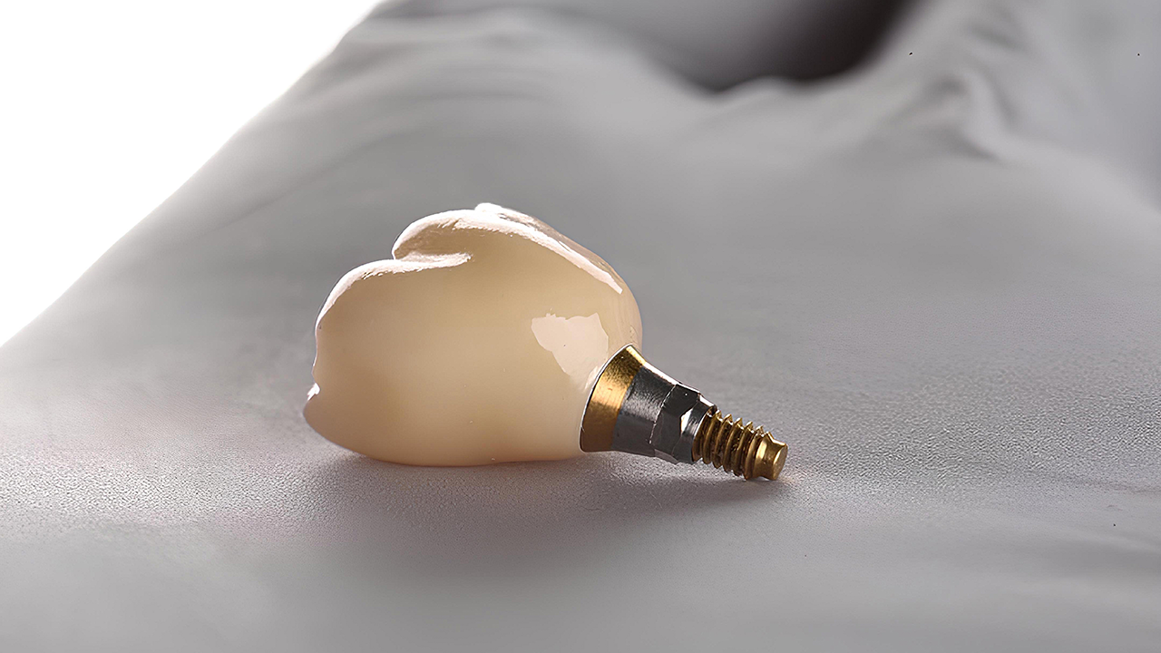 Implante Dentário: Recuperação e Cuidados no Pós-Operatório