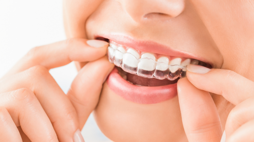 Invisible braces