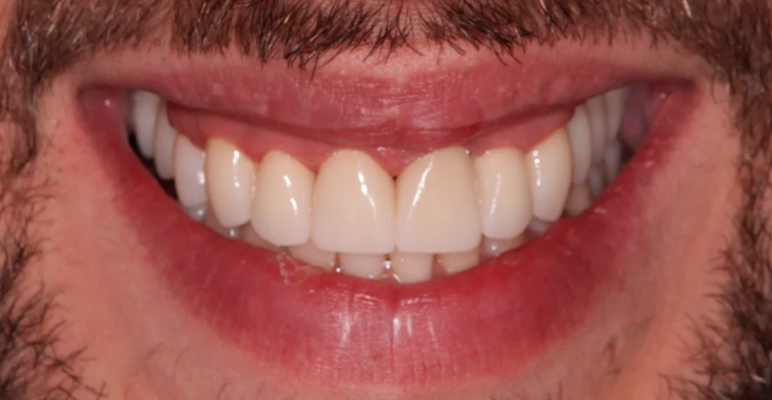 Antes