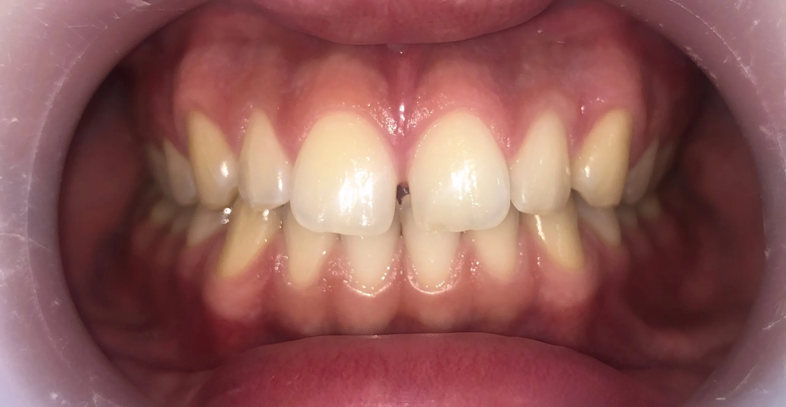 Antes - Traitement orthodontique avec des aligneurs