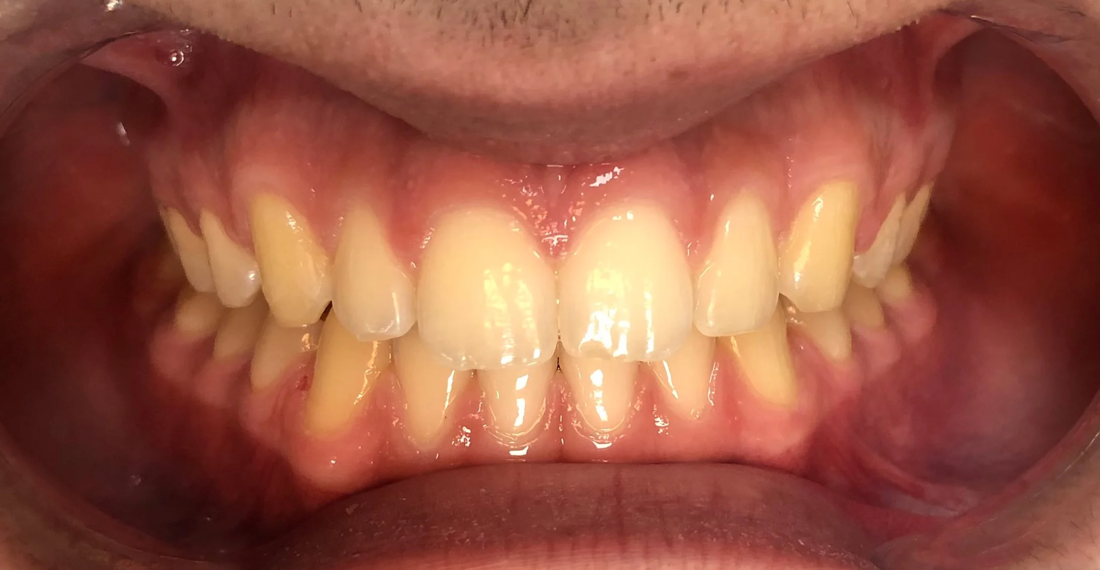 Depois - Traitement orthodontique avec des aligneurs