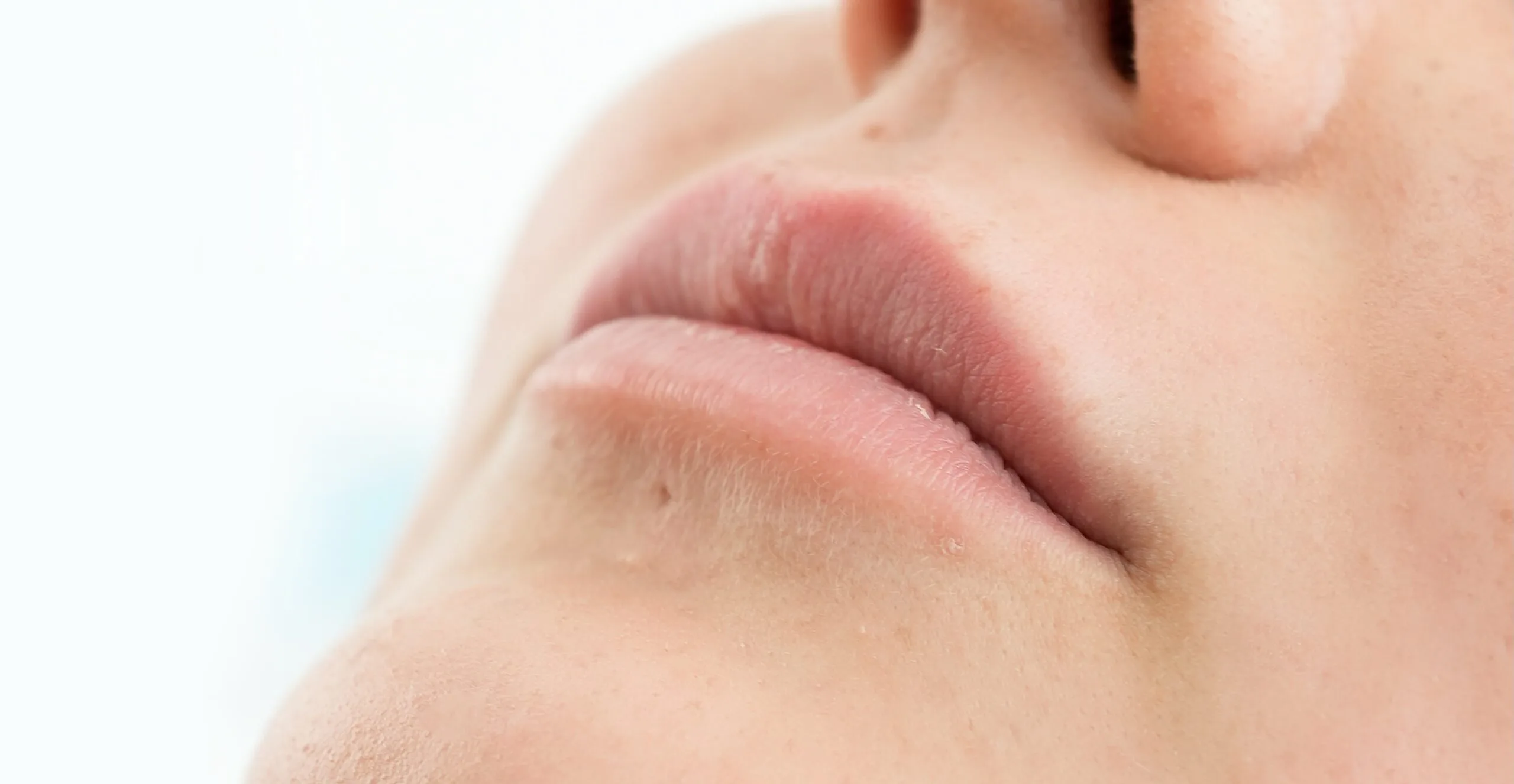 Antes - Injection de remplissage des lèvres
