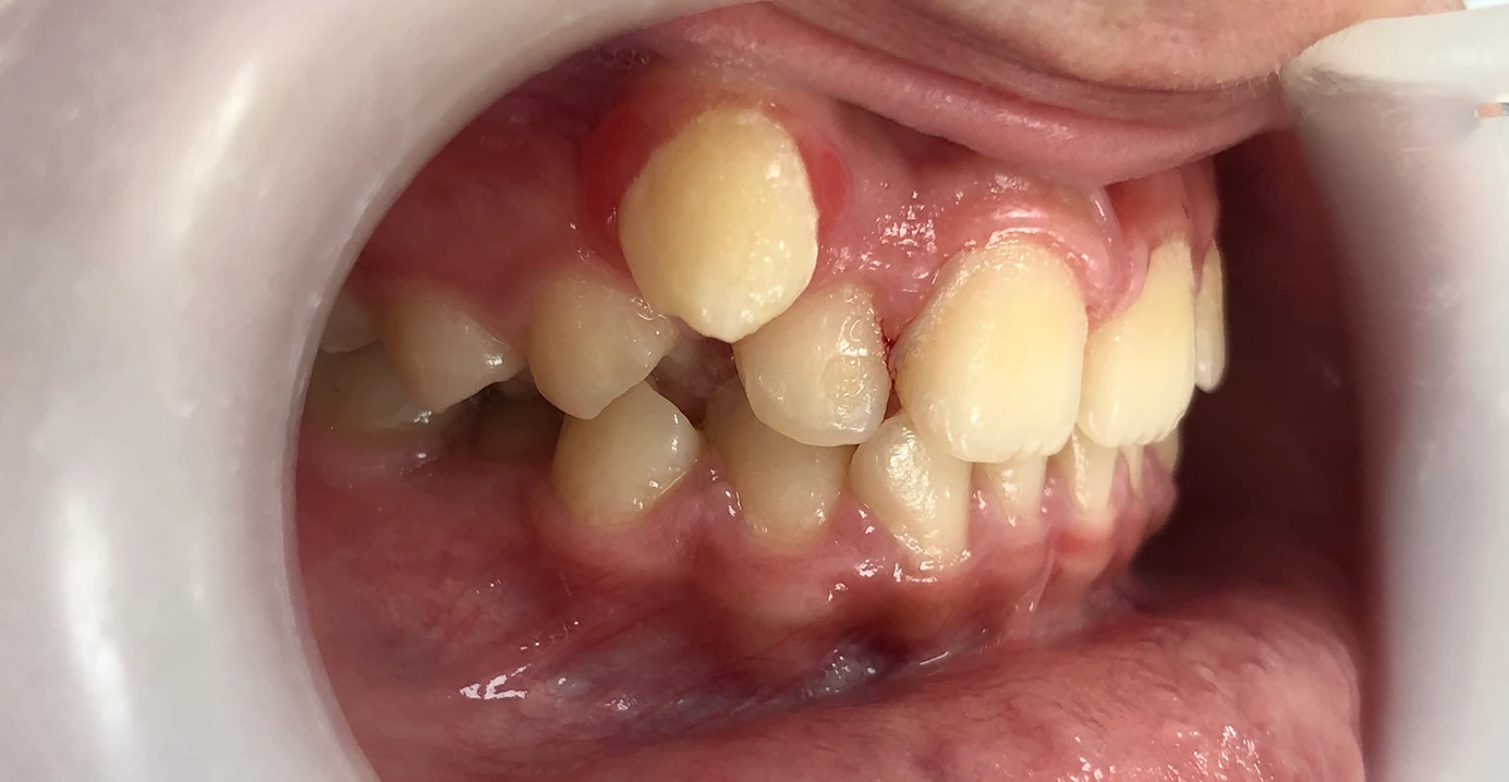 Antes - Traitement orthodontique avec appareil dentaire fixe