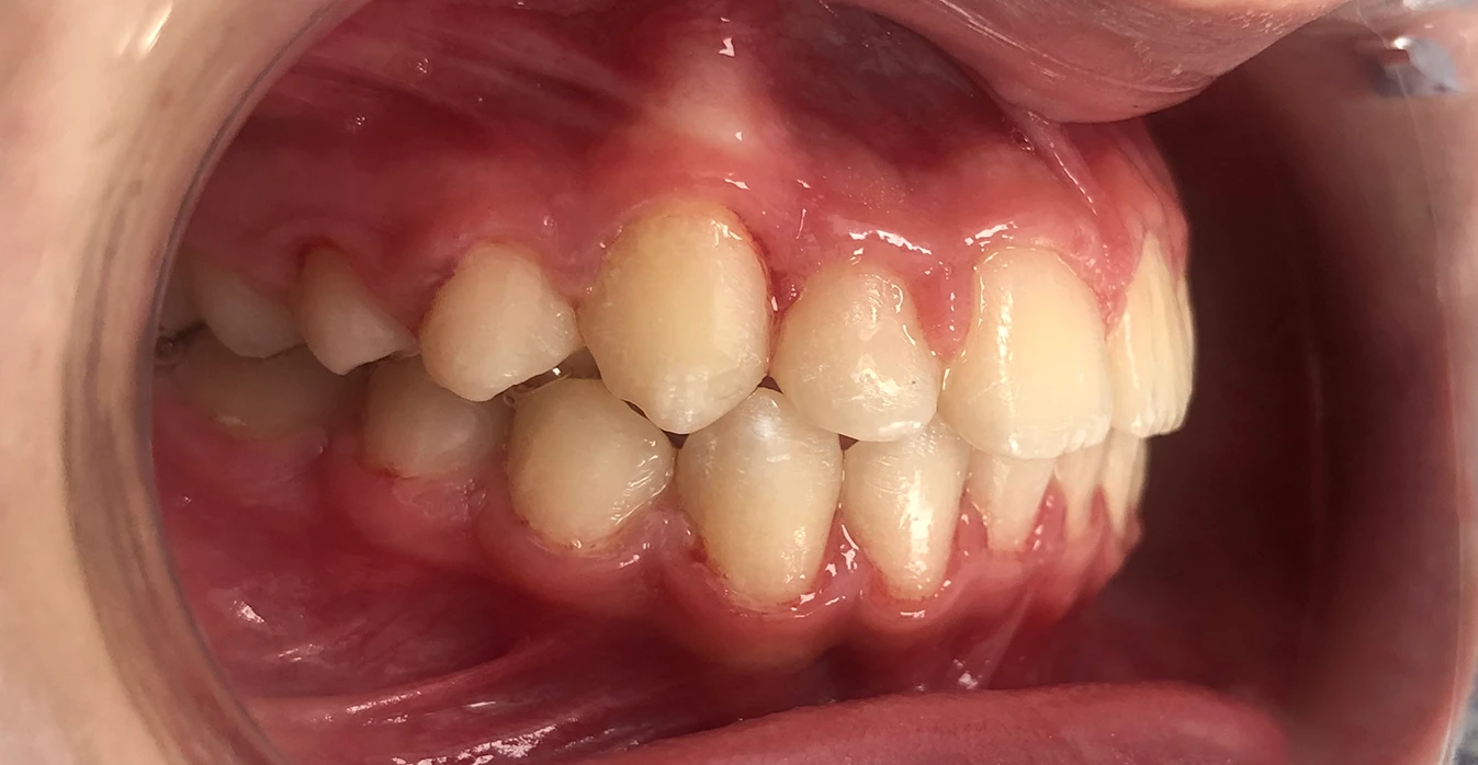 Depois - Traitement orthodontique avec appareil dentaire fixe