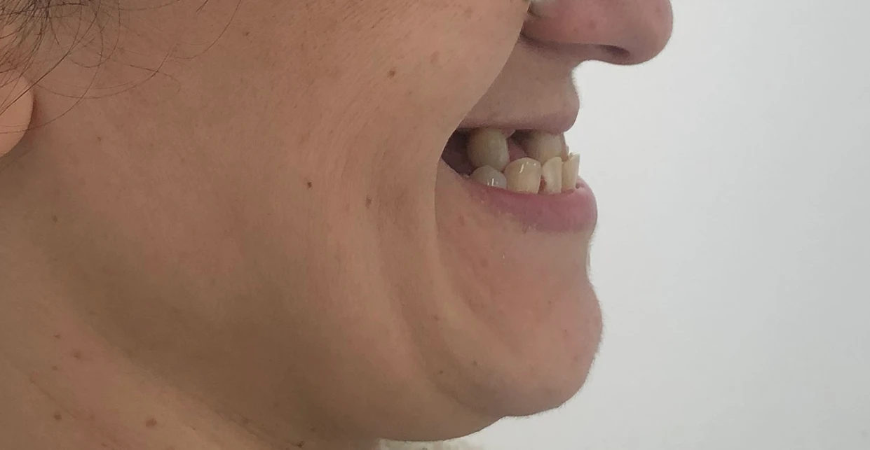 Antes - Tratamento integrado com ortodontia com aparelho fixo e com prótese fixa superior sobre implantes