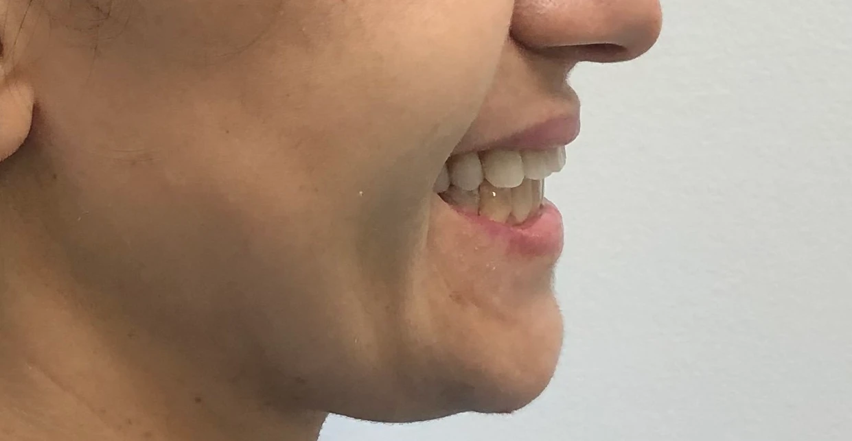 Depois - Tratamento integrado com ortodontia com aparelho fixo e com prótese fixa superior sobre implantes