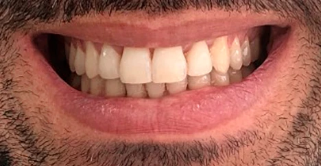 Depois - Traitement orthodontique avec un appareil dentaire fixe autoligaturant