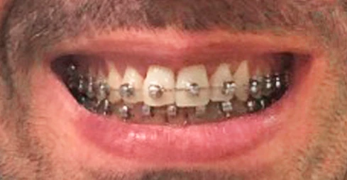 Antes - Traitement orthodontique avec un appareil dentaire fixe autoligaturant